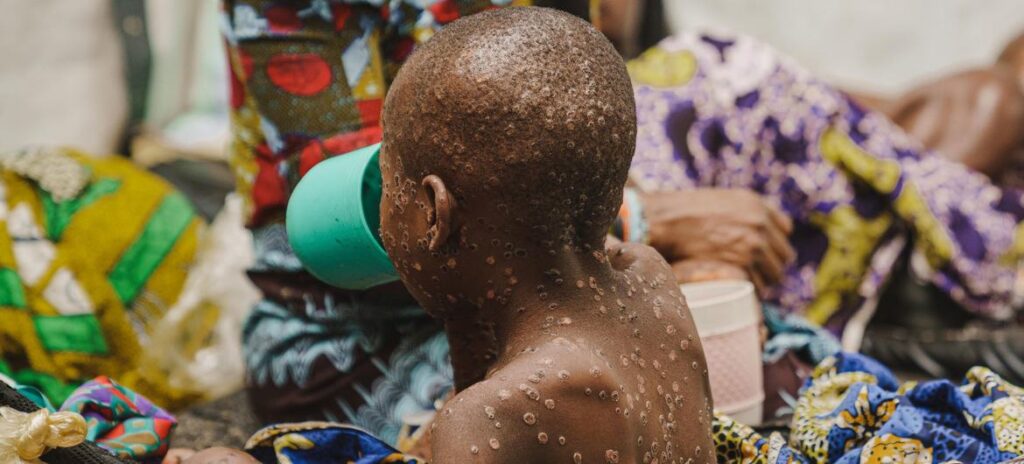 Uma criança com mpox na unidade de isolamento da doença no Hospital Kavumu, apoiado pela Unicef, na província de Kivu do Sul, República Democrática do Congo, em 23 de julho de 2024